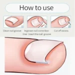 Professional Ingrown Toenail Toolkit Nail Corrector Kit Foot Care Pedicure - Image 6